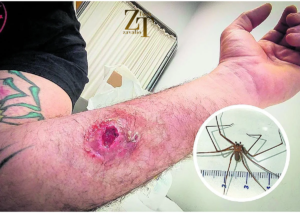 Spider Bites Pictures: How to Identify, Treat, and Prevent Dangerous Spider Bites