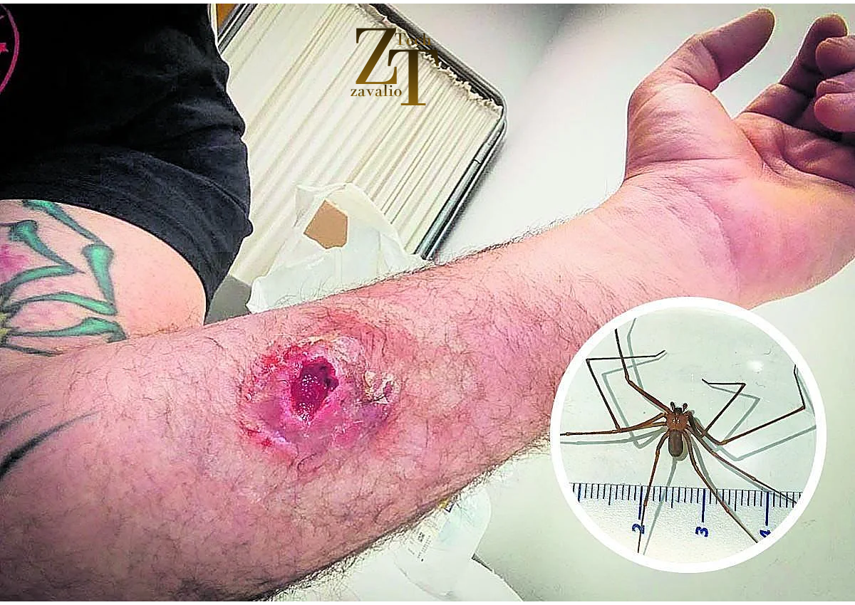 Spider Bites Pictures